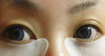 双眼皮埋线多长时间可以消肿_双眼皮埋线两年后一侧眼睛肿