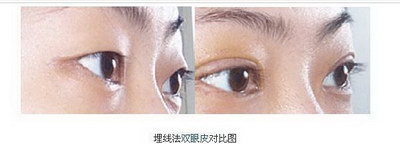 双眼皮大小眼多久能恢复_割完双眼皮1个月大小眼