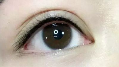 我的双眼皮手术:让我眼睛可以更开朗看世界(眼睛做过斜视手术可以做双眼皮吗)