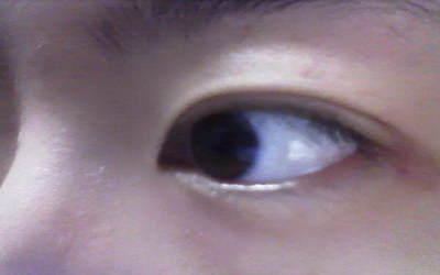 长期黑眼圈是什么原因造成的