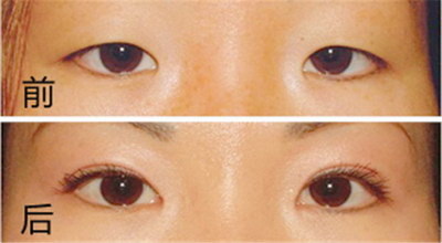 双眼皮手术变化过程