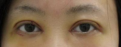 双眼皮手术失败怎样修复