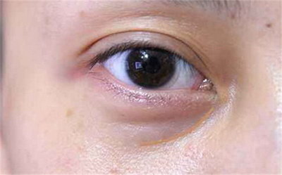玻尿酸眼窝填充术前后照片