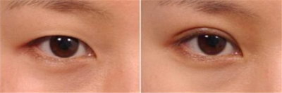 7mm全切双眼皮扇形_疤痕体质可以做全切双眼皮吗