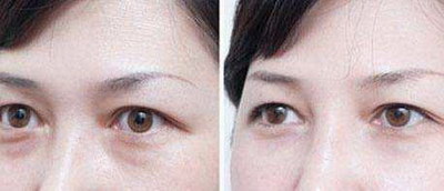 双眼皮祛眼袋要多久可以恢复好_切双眼皮的肉条要多久才能消失