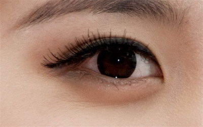 开眼角联合割双眼皮能保持多久