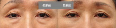 北京埋线双眼皮整形哪里好_做埋线双眼皮手术能永久吗