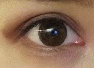 左眼上眼皮肿了是怎么回事_上眼皮吸脂恢复过程图片