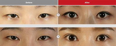 双眼皮现在有几种方法
