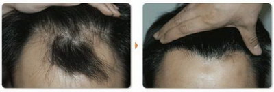 丙二醇对头发的作用与功效_不熬夜掉的头发还能长出来吗