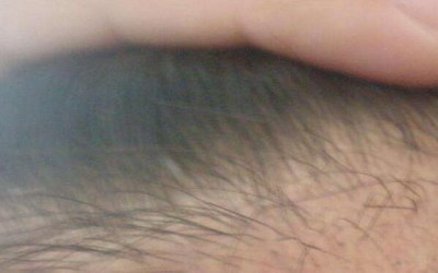发际线到眉头几厘米算正常_刺激毛囊再生发际线靠谱吗
