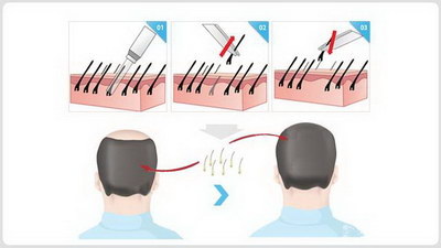 发旋可以通过植发来改变位置