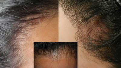 发际线高还有点脱发怎么补救_发际线高和头发多少有关系吗