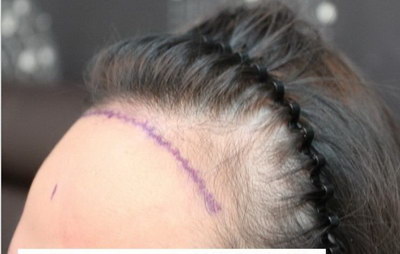发际线高想植发要注意什么_先天性发际线高可以植发吗