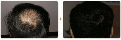 发际线往后移能做修复种植头发_人工种植头发是什么意思