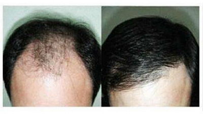 植发50天头发几乎掉光(植发后一个月头发几乎掉光了)