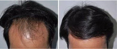 额头前面头发稀少是什么原因造成的_额头比较凸前额头发稀少