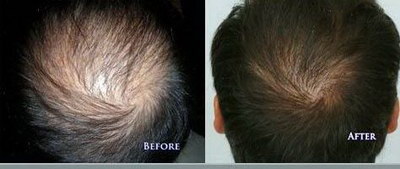 免疫力脱发毛囊是怎样的_双氧水对头发毛囊的损害