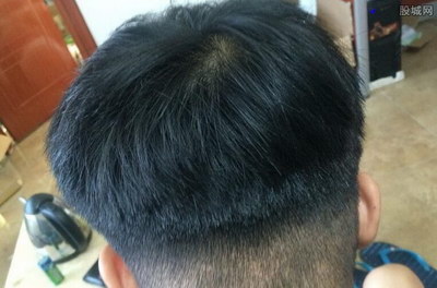 做植发手术哪里最安全有效_植发手术后两个月了头发还少