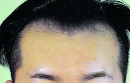 发际线偏高能用头发种植吗_十几年的疤痕可以头发种植吗