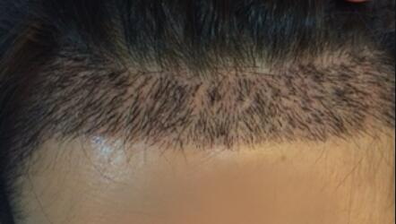 植发第十天为什么感觉很稀_植发的正确步骤和治疗方法