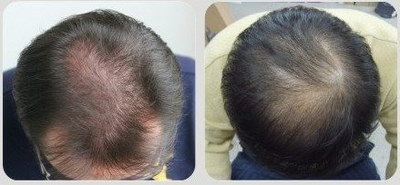植头发能保持多久_种植头发多久才长