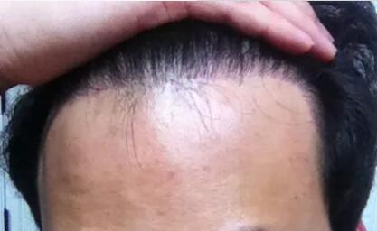 哪里有头发种植机构_头发种植的手术步骤