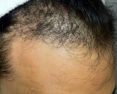脖子后面头发根处里面有个包_吃什么头发能变黑不用再染发