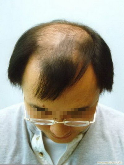 去毛囊角质多久才能长出来_北京哪些机构能做毛囊检测