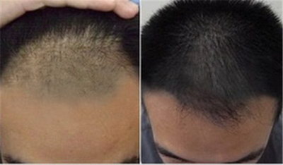北京种植头发的过程_北京种植头发的地方