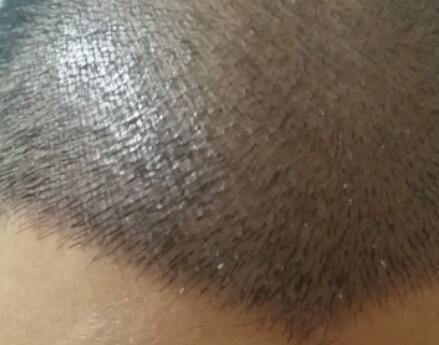 到底植发1500个单位是多少_剃发植发后面的头发能长出来吗
