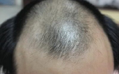 做头发种植有什么危害_南京那里可以头发种植