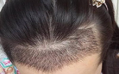 郑州种植头发哪个医院较好_种植头发到底靠谱不