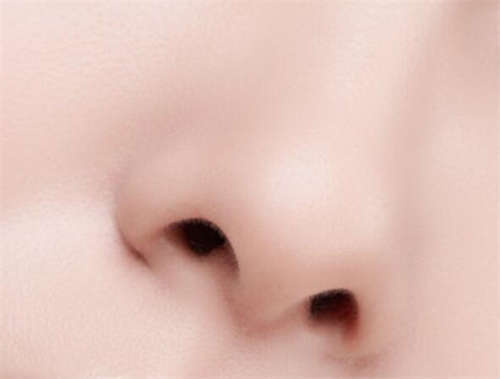 假体垫鼻后有哪些注意事项!垫鼻子的副作用?