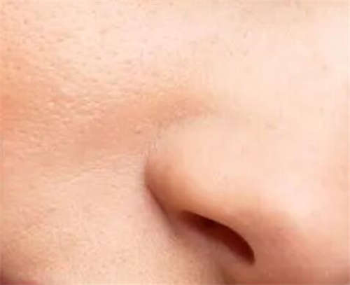 驼峰鼻矫正后多久能恢复_驼峰鼻矫正多少钱,驼峰鼻矫正是大手术吗