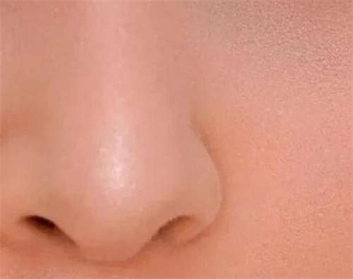 鼻唇沟填充术术前注意事项有哪些