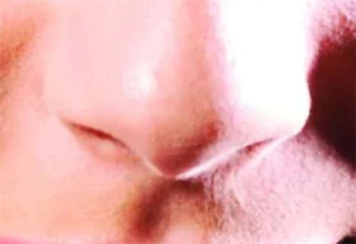 鼻背纹的形成原因是什么?形成原因
