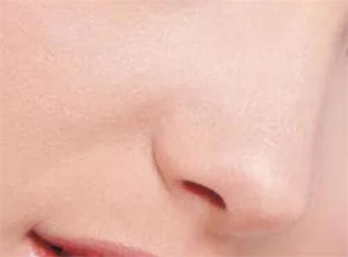 2023年大庆市大同区注射去鼻唇沟整形美容外科价目表_注射去鼻唇沟多少钱一次!